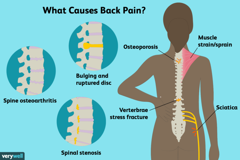 Kas izraisa muguras sāpes?